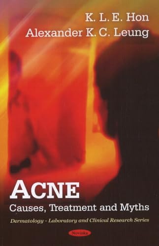 Acne: Causes, Treatment and Myths