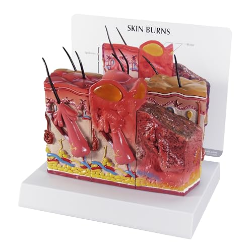 Image of GPI Anatomicals Skin Burn Model, Cross-Section Model Showing Burnt Skin | Human Body and Anatomy Replica for Physiology Education, Anatomical Model for Doctor's Office, Medical Learning Resources