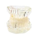Zahnmodell mit Zahnspange,Transparentes Zahn-Modell, Implantat Zahnmodell, Kieferorthopädisches Dentall Modell, Implantat-Demo mit abnehmbarer Krone/Brücke für die Ausbildung (Transparent)
