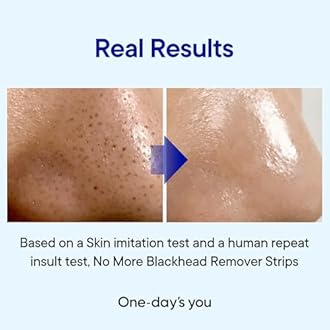 ONE-DAY’S YOU P.Z. Ssoc Ssoc No More Blackhead 3.38 Fluid Ounce, Removing Bla...