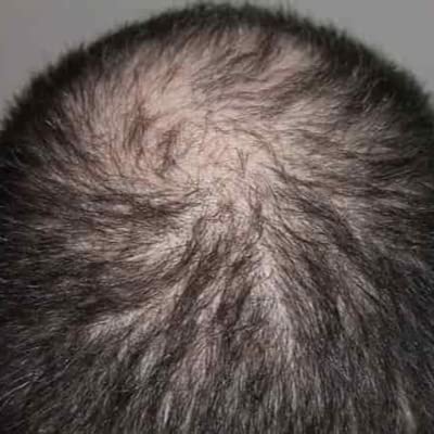 『Sugary Beverages to Blame for Male Pattern Baldness』のカバーアート