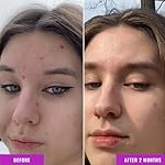 Good Molecules Niacinamide Serum - 10% Niacinamide to Target Acne, Nourishment, and Skin Tone - Ultra Hydrating Serum and Brightening Skin Care for Face - Image 4