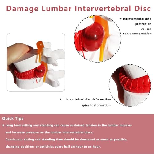Modelo de columna lumbar con disco intervertebral aumentado 1,5X 4