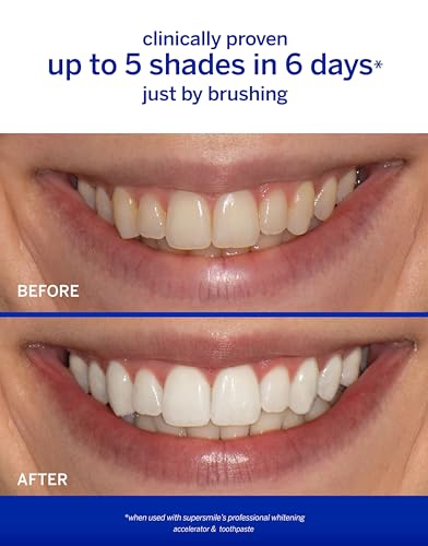 Image of Supersmile Rosewater Mint Fluoride-Free Whitening Toothpaste, 4.2 oz, Professional Whitening Toothpaste with Calprox, Whitens 5.5 Shades in 7 Days, RDA 65 Low Abrasion, Enamel Safe for Veneers