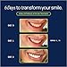 Laughland Super Strength Teeth Whitening Kit, Phone-Powered LED Mouthpiece & 3 Whitening Gel Syringes, 11% Hydrogen Peroxide, Glycerin, Aloe Vera & Mint, at Home Dental Care, 6+ Treatments