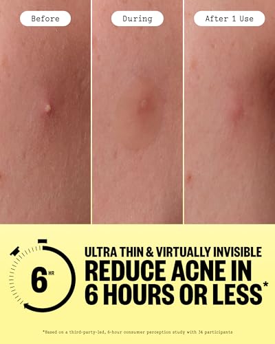 PEACE OUT Acne Day Dot Sheer Hydrocolloid Pimple Patches (40 count) — view 4