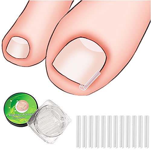 (30+2) Pack Ingrown Toenail Correction Treatment Kit, 30Pcs Ingrown Toenail Corrector Strips Brace Ingrown Toenail Pedicure Tool Toenail Correction Patch With 2Pcs Ingrown Toenail Lifter And File #TOP6