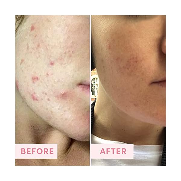 Sand & Sky Australian Pink Clay Porefining Mask for Blackheads. Evens skin tone.