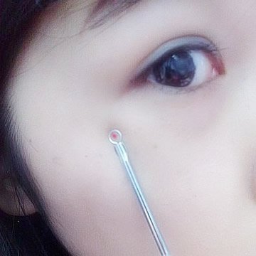 HDE (TM) Skin Care Product - Blackhead Removal Device