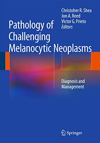 Pathology of Challenging Melanocytic Neoplasms: Diagnosis and Management