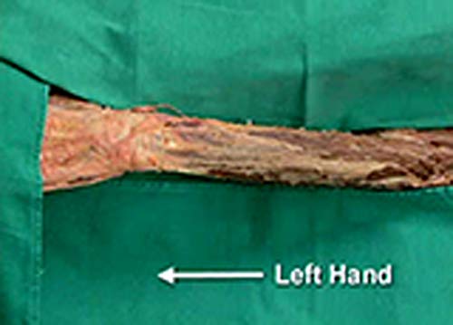 Upper Limb - Extensor Surface of the Forearm and Dorsum of the Hand (English Edition)