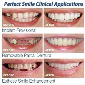 Instant Perfect Smile Comfort Fit Flex Teeth Veneers – Natural Denture Covers for Upper and Lower Teeth, Whiten & Enhance Smile, Easy Fit, Removable Cosmetic Dental Solution 1