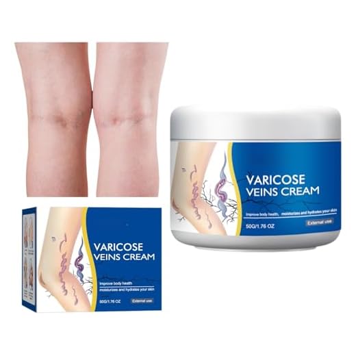 Varicose Veins Treatment for Legs, Spider Varicose Veins Relief Cream, Treatment for Veins on Legs, Skin Cream for Legs 50g/1.76fl.oz (1)