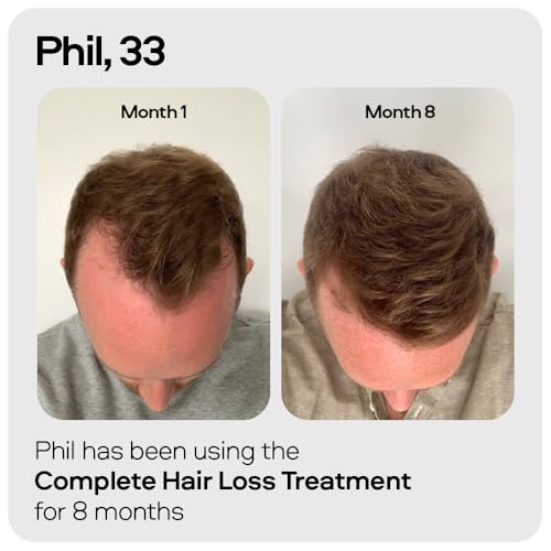 Sons Minoxidil 5% Spray (3x60ml) & 0.25mm Dermaroller for Men, Clinically Proven Hair Regrowth Formula, Hair Loss Treatment, Stimulates Follicles, Precise Applicator, Microneedling Boosts Absorption - Image 3