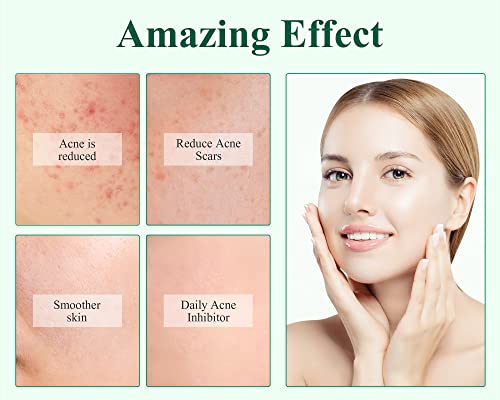 Breylee Acne Treatment Tea Tree Oil Face Cream For Prone Face Sensitive Skin Care, Cystic Acne Pimples Scars Remover, Glycolic Acid, Centella Asiatica, Acne Prevention, Soothing & Calming(20Ml,0.7Oz) #TOP1