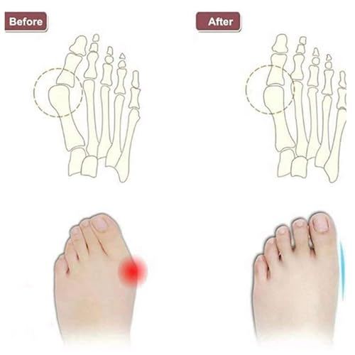 CLSQLXYJZC Men Toe Corrector Sandal, Men's Orthopedic Slip-On Plus Size Bunion Corrector Sandals with Arch Support, Open Toe Utdoor Beach Holiday Flip Flops, for Dad Men Grandpa, Bunion Relief4