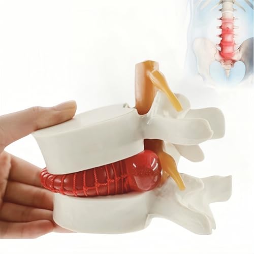 Human Anatomical Lumbar Disc Herniation Model 1.5 Times Life Size Lumbar Spine Model for Teaching and Learning (1pc Spine and Disc Model)