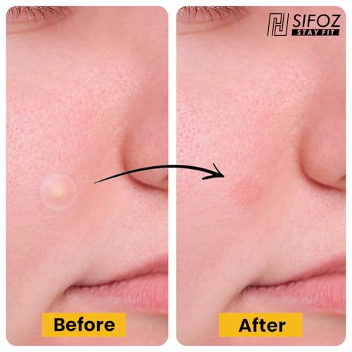 Image of Sifoz Acne Pimple Patch for Face - 72 Hydrocolloid Patches, Waterproof Overnight Treatment, Absorbs Oil, Reduces Scarring, Suitable for All Skin Types