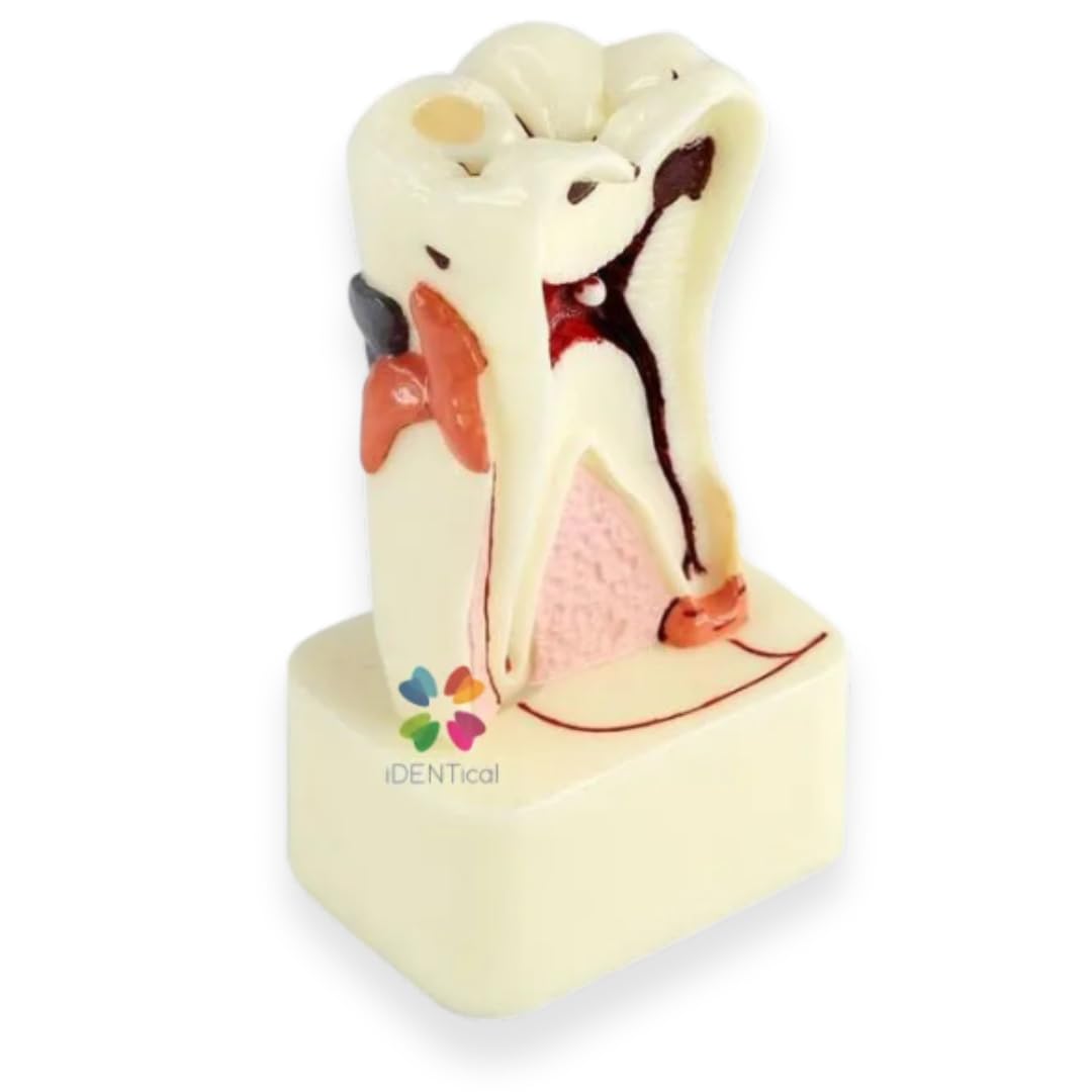 iDENTical Dental Model for 4X Pathologies of Tooth M4015 | Educational Tool for Dental Students & Professionals | Accurate Anatomy & Detailed Representation of Common Dental Pathologies