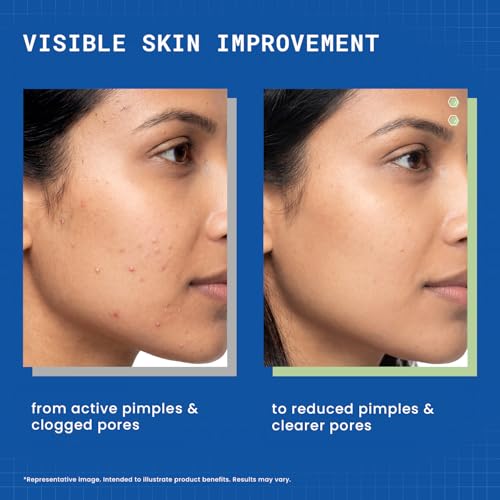 Image of DERMDOC 2% Salicylic Acid w /w Pimple Gel, 5ml | Acne Spot Treatment for Oily & Acne-Prone Skin | Reduces Pimples, Redness & Inflammation | Clears Clogged Pores | Lightweight & Fast Absorbing | Anti-Acne Gel for Breakouts & Active Pimples