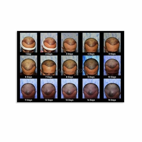 Hair Transplant Cycle Poster Canvas Wall Art 36x24inch