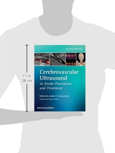 Cerebrovascular Ultrasound in Stroke Prevention and Treatment