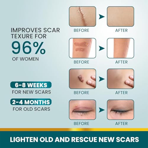 Image of Scar Removal Tape Scar Removal Sheet Strips for C-Section, Acne Scars, Tummy Tuck, Keloid and Surgical Scars, Reusable Medical Grade Silicone Scar Patches, Get Scars Away Painless Reusable
