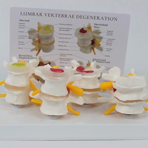 4 Stage Lumbar Vertebrae Model for Anatomy Teaching & Patient Education, Human Spine Anatomy Disease Model with English Back Card, Bone Degeneration & Advanced Osteoporosis Demonstration - Image 5