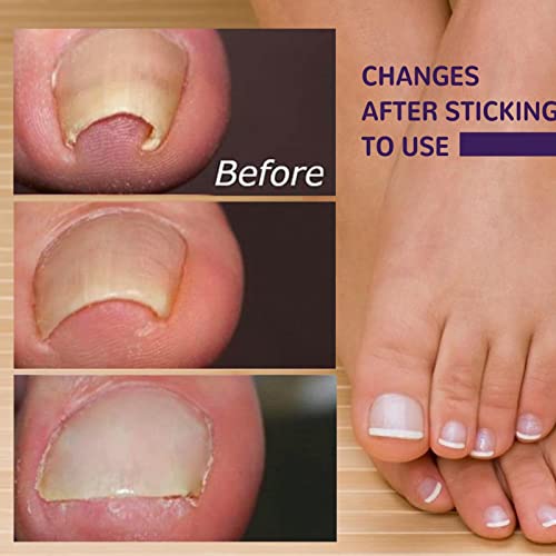 Patch de correção de unha,cuidados com os pés adesivo - Remendo de correção de unha encravada adesiv
