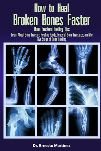 How to Heal Broken Bones Faster. Bone Fracture Healing Tips: Learn About Bone Fracture Healing Foods, Types of Bone Fractures, and the Five Stages of Bone Healing (Health and Wellness)
