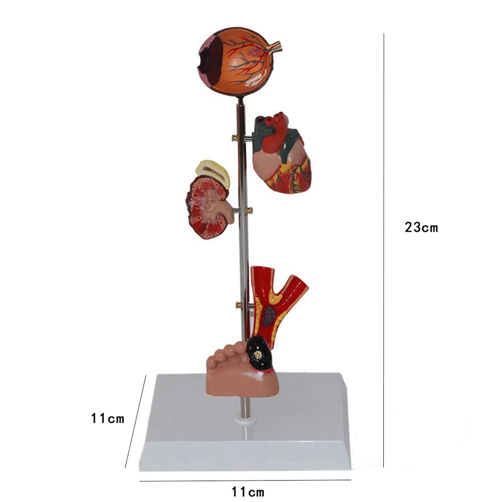 Modèle De Diabète Médical, Modèle D'organe du Diabète, Modèle Anatomique D'organe Diabétique Pathologique, Modèle D'organe 5 Parties pour Les Médecins
