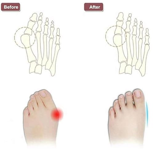 CLSQLXYJZC Summer Plantar Fasciitis Slippers Mens, Men's Slip-On Open Toe Bunion Corrector Sandals with Arch Support, Two Uses Orthopedic Large Toe Bone Corrector Flip Flops, for Dad on Christmas2