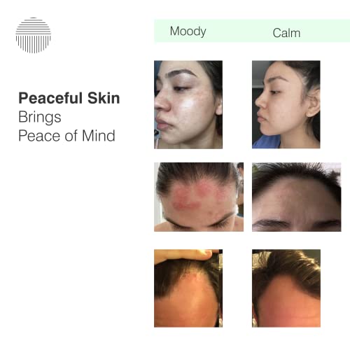 Dermazen Calming Seborrheic Serum, Dermatologist Recommended, Topical Serum For Hair, Face, And Body (4.8) #TOP4