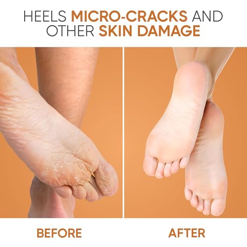 Image of Kliffoo Foot Repair Cream for Rough, Dry and Cracked Heel Feet, 20% Urea Cracked Heel Repair Balm Stick 40g, Helps Repair & Moisturise Knees, Elbows, Hands | Benefits of Shea Butter & Vitamin E