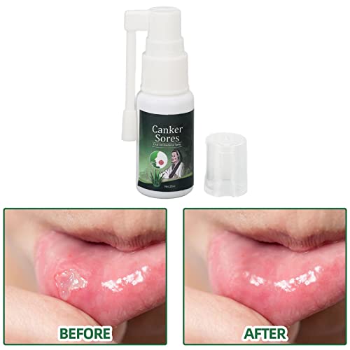 Mundspray Zur Linderung von Mundgeschwüren, Behandlung von Mundgeschwüren, Schutz von Zähnen Und Zahnfleisch, Reduzierung von Mundgeruch, Linderung von Mundtrockenheit, Behandlung von Mundgeschwüren, – Bild 4