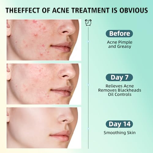 Halldeli Acne Treatment for Face, SalicylicAcid Cream, Blemish Care Formula for Skin Types, Pimple Treatment for Face & Body, Gentle Daily Care for Oily & Blemish Prone Complexions, Helps Improve Appearance