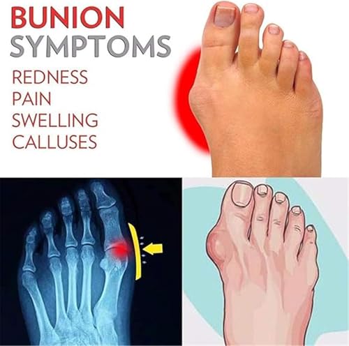 Comfy Open Toe Orthopedic Slippers, Stylish Breathable Non-slip Slip-On Bunion Corrector Sandals for Men, Black and Outdoor Open Toe Beach Flip Flops, for Papa Husband, Big Toes Bent Toes2