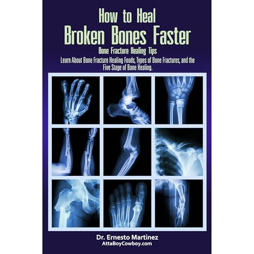 How to Heal Broken Bones Faster. Bone Fracture Healing Tips: Learn About Bone Fracture Healing...