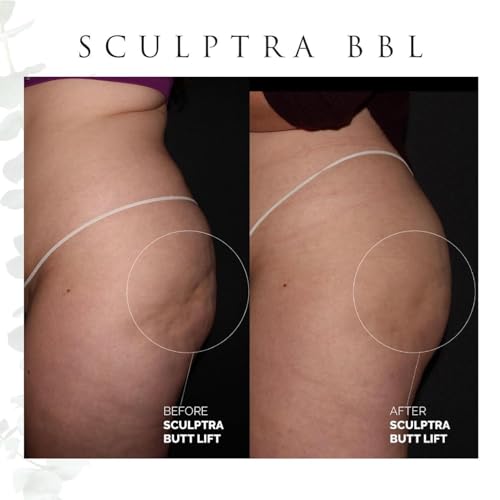 Sculptra in West lake hills - Auveau Aesthetics + Wellness