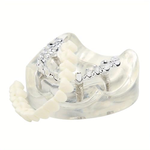 Transparent Dental Lower Jaw Implants Model Detachable Denture Model Dental Teaching Model Suitable for Education and Study