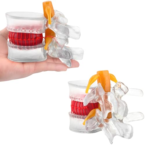 Image of Human Anatomical Lumbar Herniation Model with Nerve Root,Anatomical Vertebrae Model for Education,Excellent Way for Demonstrating Disc(Transparent)