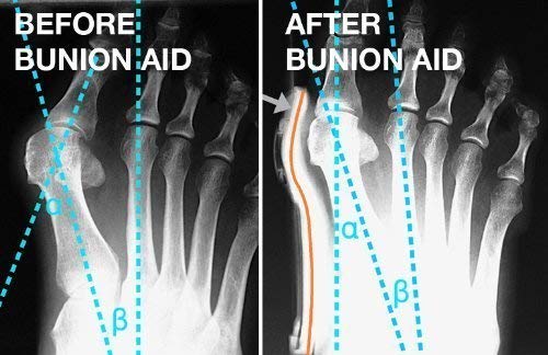 Image of Cyrox Silicon Foot Fingers Toe Separator Stretchers Straighteners Protector | Bunion Correction Toe Separator (2 Pair -Free Size) (2)