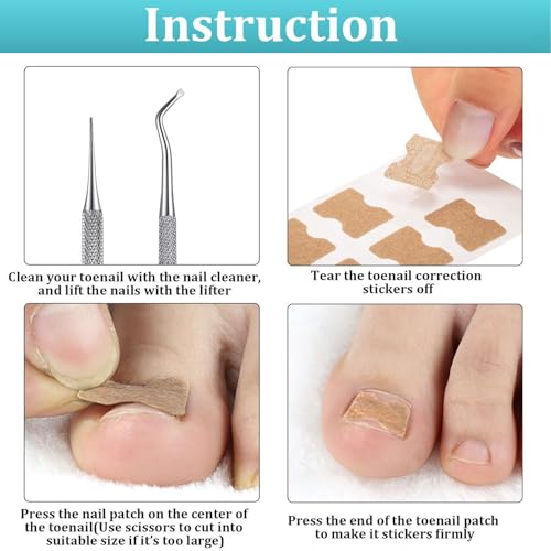 Image of 102pcs Ingrown Toe Nail Remover, Toenail Corrector Strips and Ingrown Toenail Correction Tool, for Daily Nail Care and Post-Exercise Maintenance,