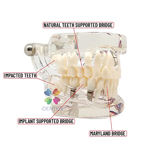 Image of iDENTical Patient Education Model (Caries, Implant, Nerves) M2001-3 | 3D Model | Featuring More than 30 Clinical Findings | Illustrative | Durable | Portable