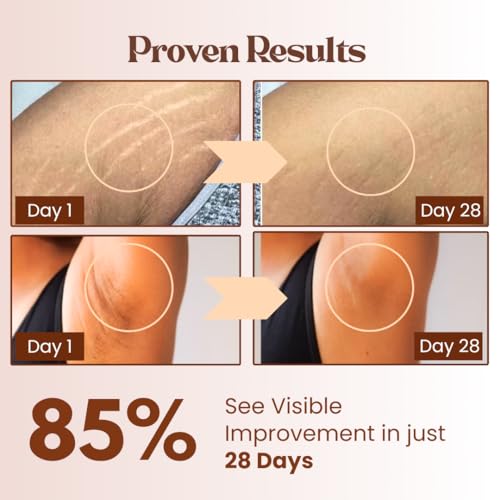 Image of POKONUT Flawless Skin Combo-Pokonut Dark Patch Removal Cream With Turmeric & Niacinamide, 50G Pokonut Natural Stretch Mark Cream With Mulethi & Hyaluronic Acid, Dermatologically Tested (50 gm, Combo - Pack of 2)