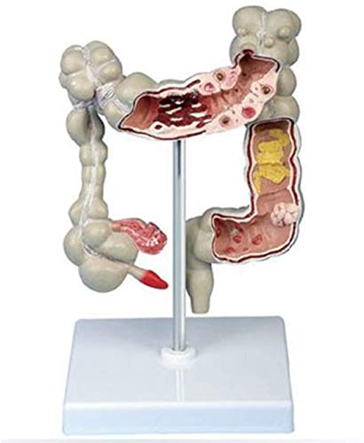 sjdoPulse Colorectal Lesion Model, Human Colorectal Lesion Model Pathological Anatomy Colon Diseases Intestine Medical Teaching Medical for Doctor-Patient Communication