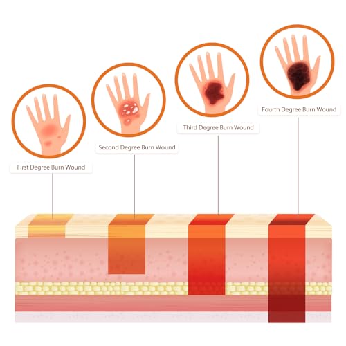 Image of Burn Wound Packing Trainer, Burn Moulages Kit, Adhesive Skin Burn Wound Trainer for Wound Care Training, Burn Wound Training Model