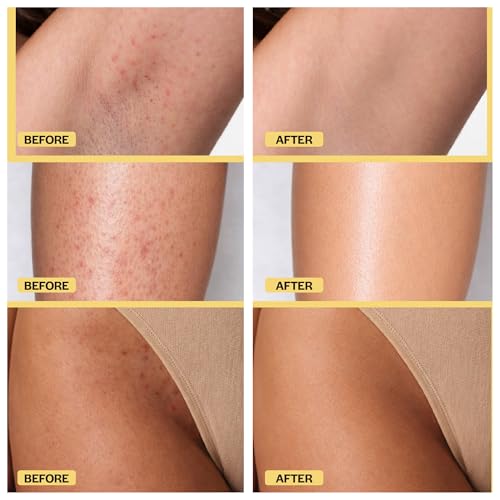 Image of BASE LABORATORIES Ingrown Hair Treatment Pads with AHA & BHA, Razor Bumps
