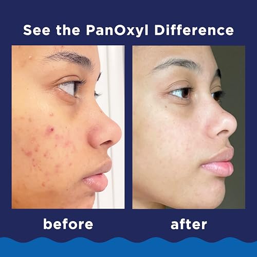 Panoxyl YYOJ Acne Foaming Wash Benzoyl Peroxide 10% Maximum Strength Antimicrobial thumb #3