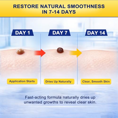 Skin Tag Removal Kit For Home Use, Featuring Precise And Controlled Pain-Free Application, Easy To Use Even For First-Time Users, Removes Skin Tags In 7–14 Days, Everyday Comfort And Confidence, 30 Ml - 3